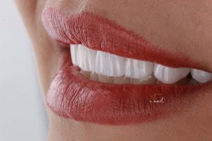 لمینیت دندان در مشهد